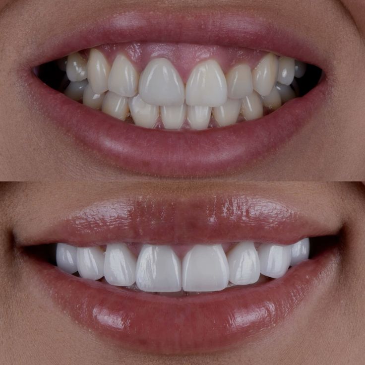 BRIGHTOLOGY™ - Teeth Whitening Powder